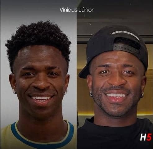 Lire la suite à propos de l’article 😏Vinicius Jr cède à la chirurgie esthétique et change visage